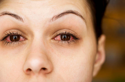 눈 충혈-눈꺼풀염-설명하는-사진