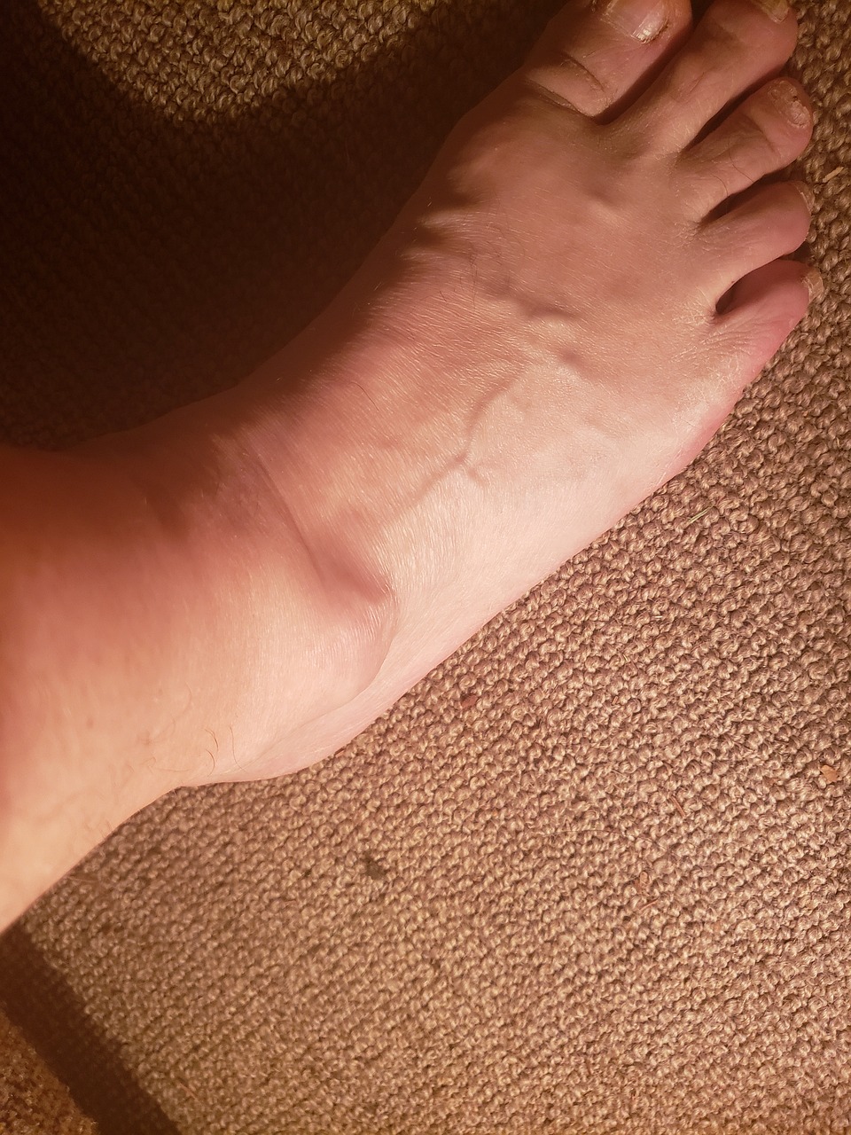 결절종(Ganglion)
