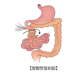 장폐색 증상