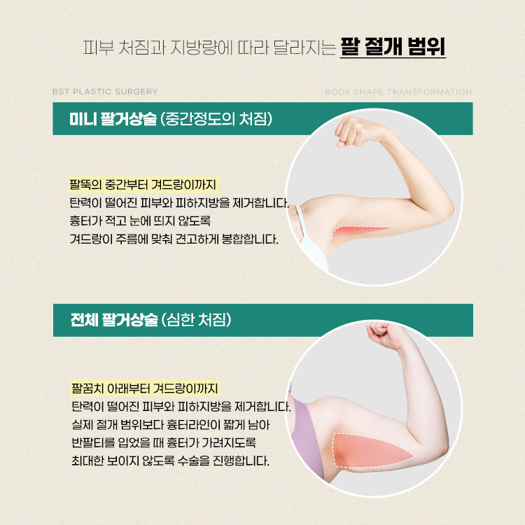 1. 미니 팔거상술 (중간정도의 처짐)
팔뚝의 중간부터 겨드랑이까지 탄력이 떨어진 피부와 피하지방을 제거합니다. 흉터가 적고 눈에 띄지 않도록 겨드랑이 주름에 맞춰 견고하게 봉합합니다.
2. 전체 팔거상술(심한 처짐)
팔꿈치 아래부터 겨드랑이까지 탄력이 떨어진 피부와 피하지방을 제거합니다. 실제 절개 범위보다 흉터라인이 짧게 남아 반팔티를 입었을 때 흉터가 가려지도록 최대한 보이지 않도록 수술을 진행합니다.