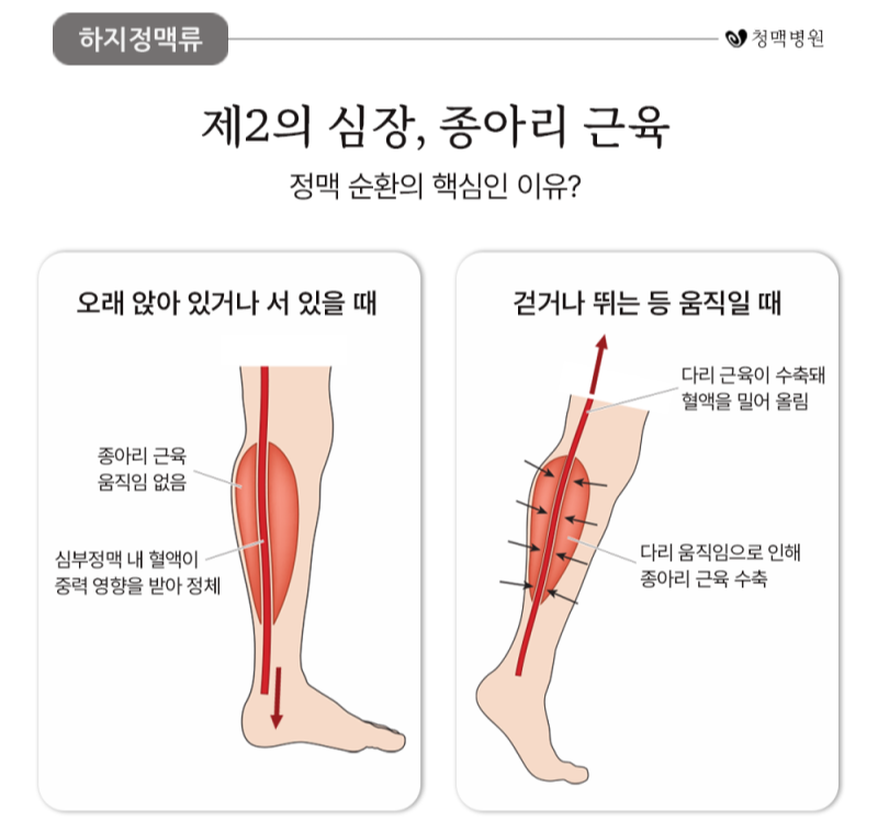 alt="하지정맥류"