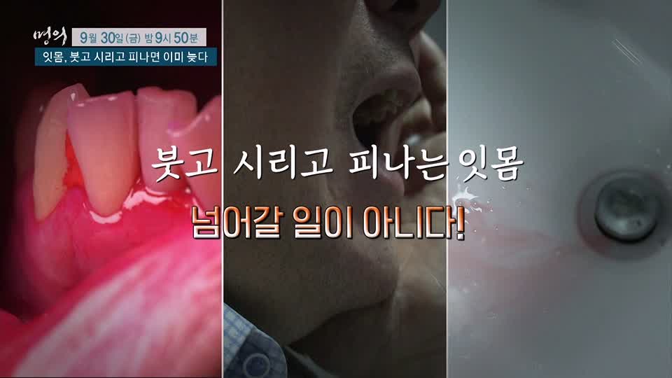 명의 붓고, 시리고, 피나면 이미 늦는 치주염 잇몸 질환 치주질환 치료, 예방 방법