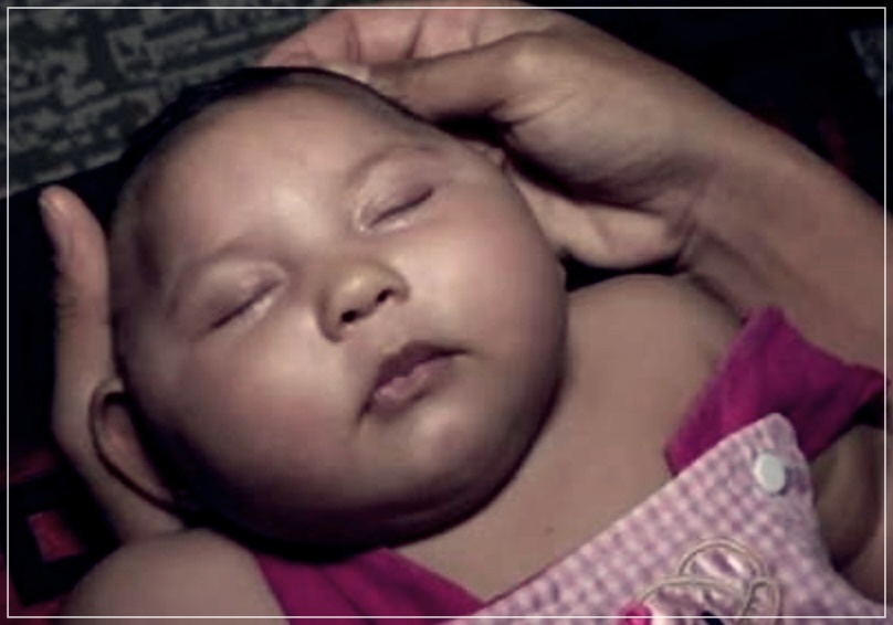 소두증 이란? 원인, 증상, 치료방법들