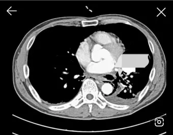 폐에 물이 차는 원인 증상 물참 관리 포인트에 대한 건강정보_20