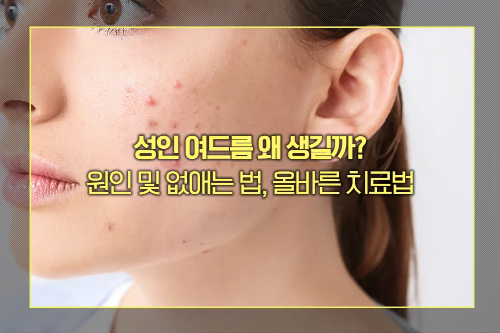 성인 여드름 원인 및 없애는 법