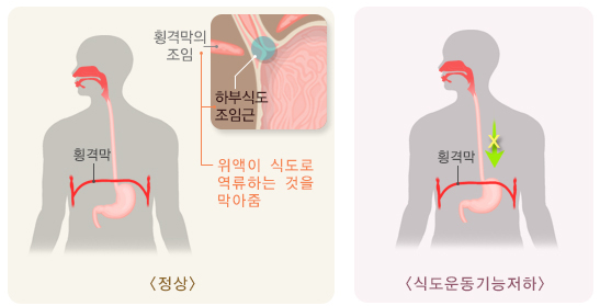 역류성 식도염
