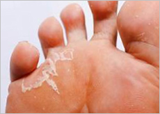 카네스텐 연고가 필요한 무좀 증상 발 이미지