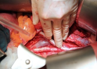 대장암 초기증상 혈변 원인