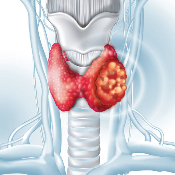 갑상선기능저하증 증상