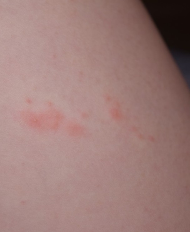 대상포진-초기증상