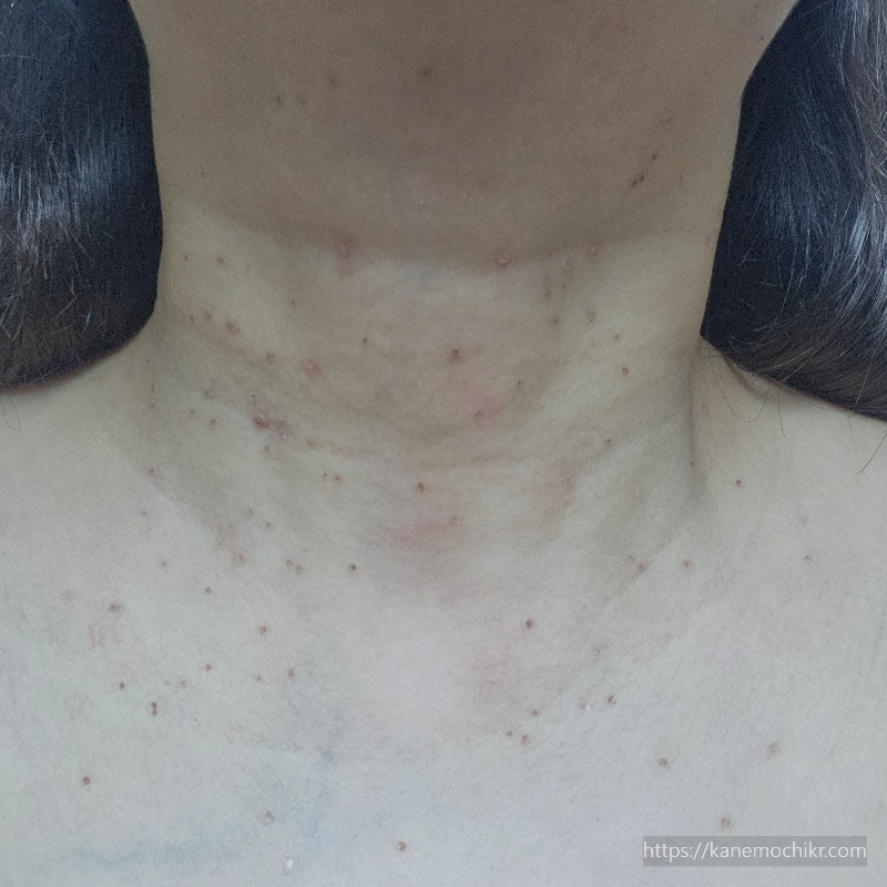 쥐젖-편평사마귀-제거-7일