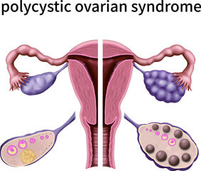 이노시톨 효능&amp;#44; 난임과 인슐린 관계를 알아봤습니다. 이노시톨이 우리 인체에 어떤 긍정적인 작용을 하는 지와 이노시톨이 어떤 물질인지 천천히 읽어 보시기 바랍니다.