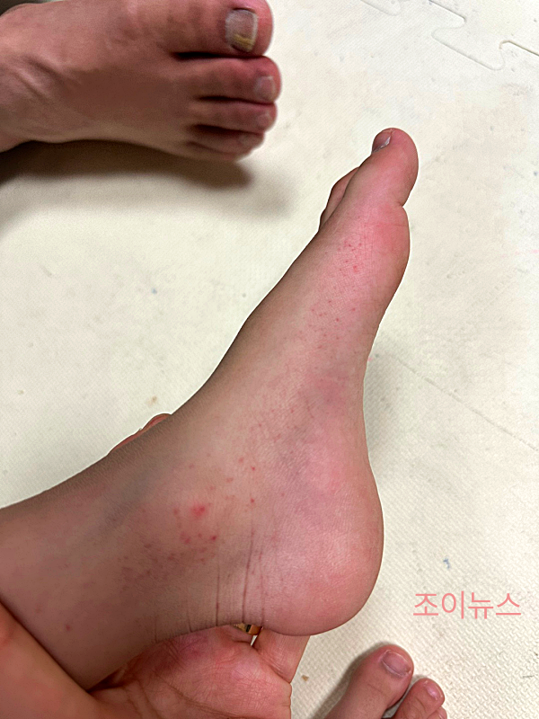 아이가 가려움증을 호소했던 발 부위