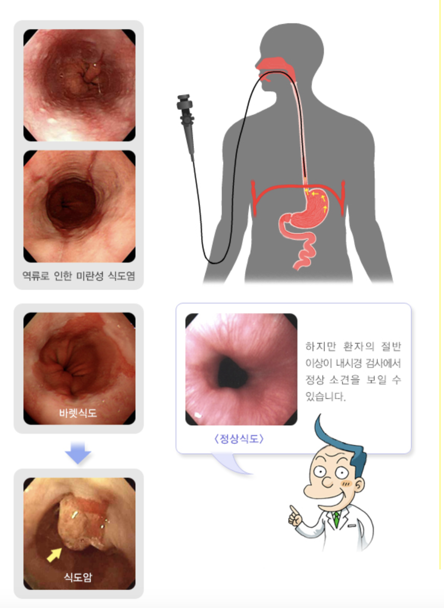 위내시경 검사