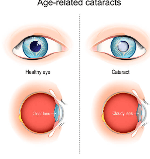 백내장 수술비용