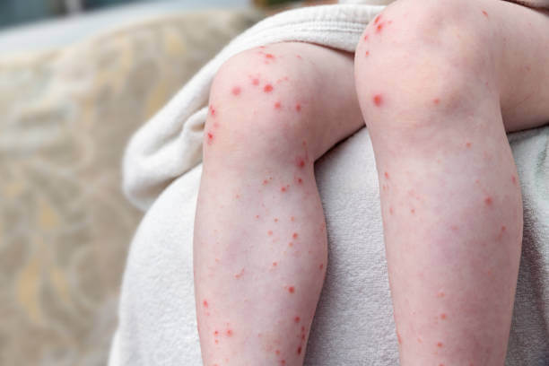 대상포진 예방접종 가격