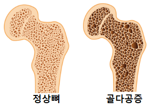 정상뼈과 골다공증 상태인 뼈
