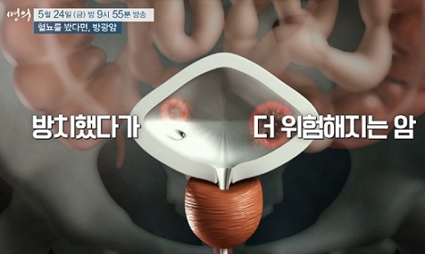 방광암