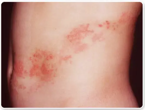 대상포진-증상이-발병하면-나타나는-띠-모양의-수포-발진-모습