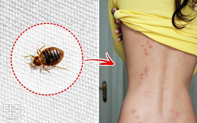 빈대 물린자국 확인,건강