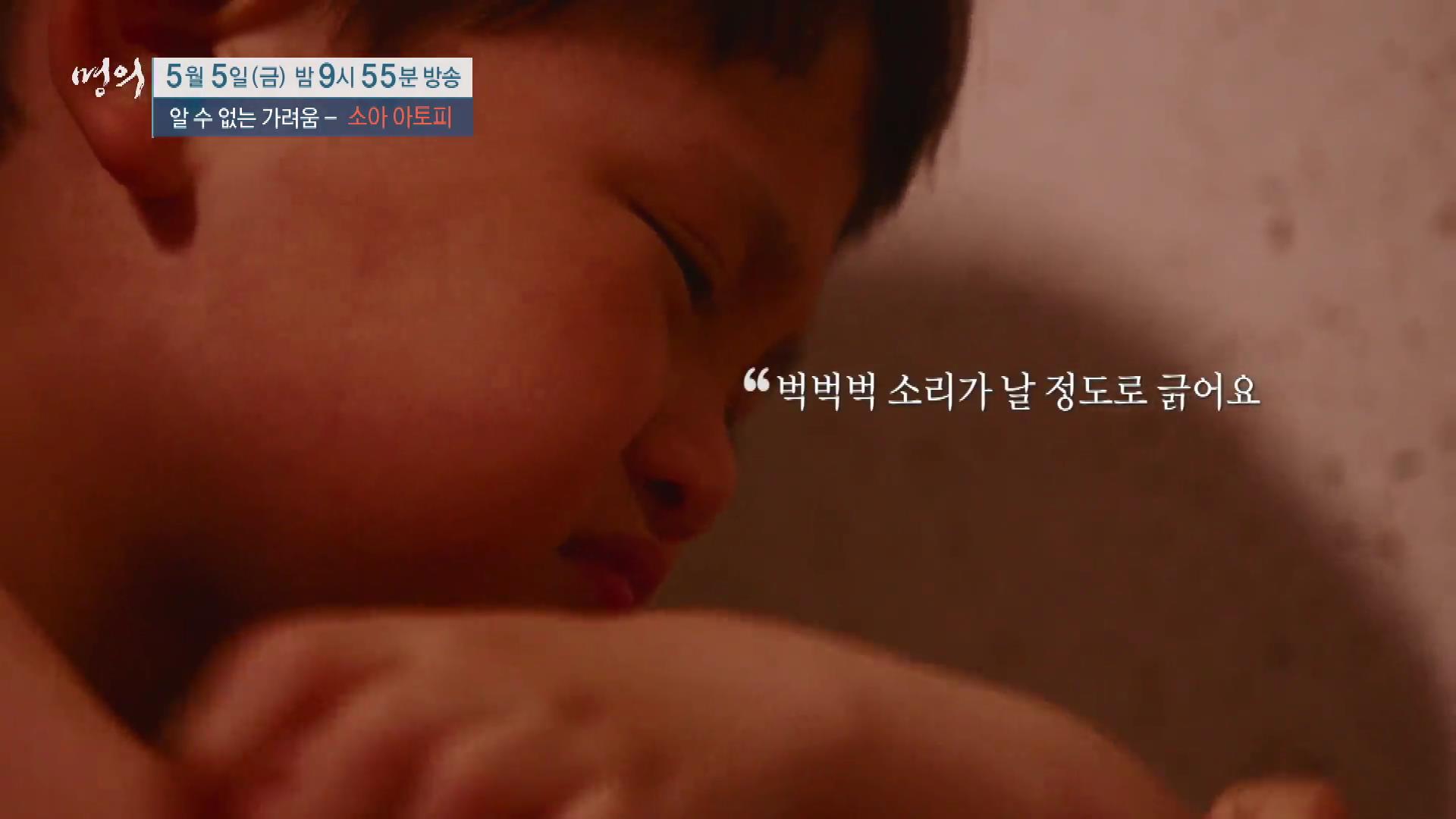 명의 어린이 소아 아토피 피부염 스테로이드 효과 및 부작용 완치 치료제 신약 비용 방법