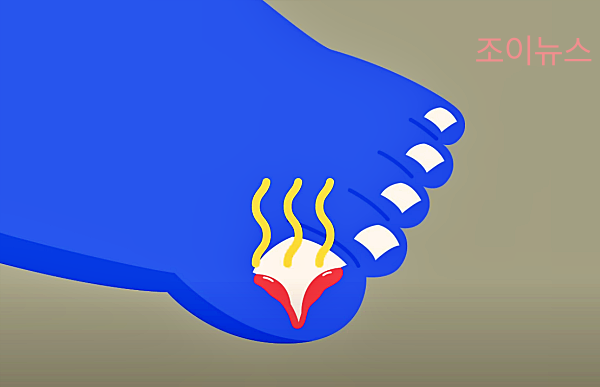 내성발톱 증상_출처:은근한잡다한지식