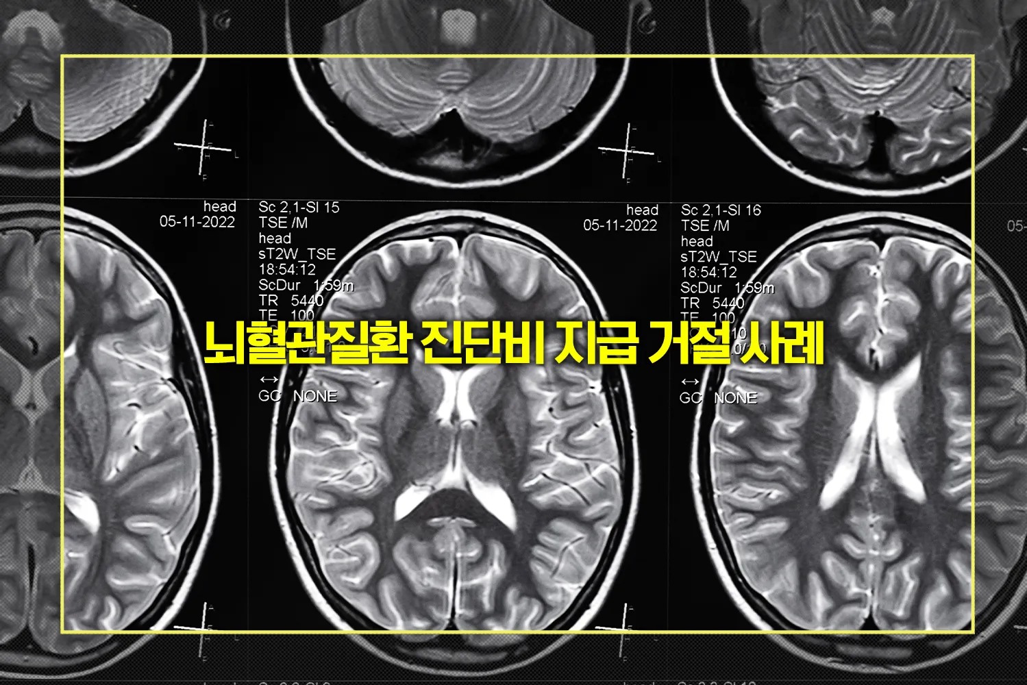 비파열성-뇌동맥류-보험금-거절-대응법