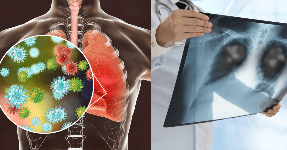 병균이 확대되어 보이는 폐와 엑스레이에 보이는 감염된 폐