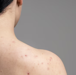 대상포진 초기증상 20