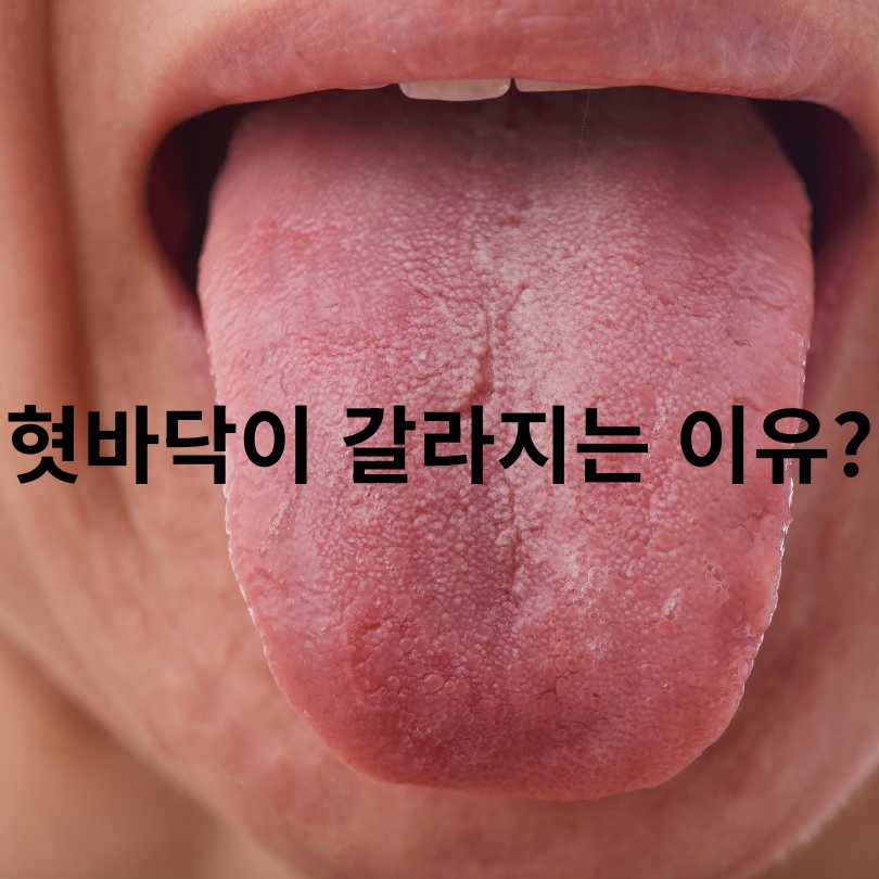 혀 갈라짐의 원인과 대처법