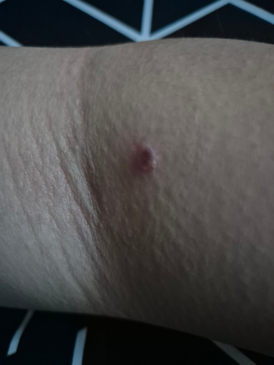 수두 증상 원인 격리 치료 및 예방방법 