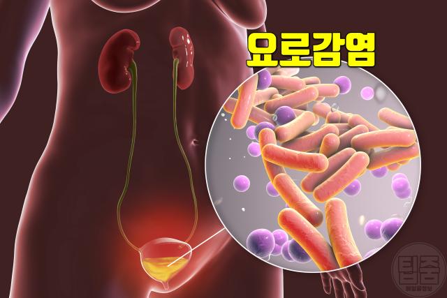 방광암 증상 요로감염