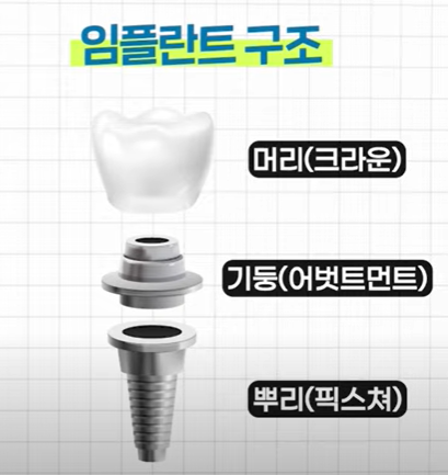 임플란트 구조