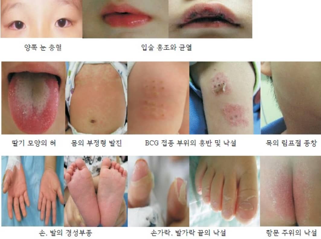 가와사키병의 증상 사진들
