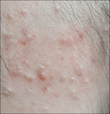 에스로반 연고 효능 가격 부작용