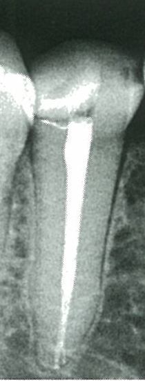 근관 충전 사진