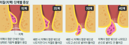 치질의_증상별_단계