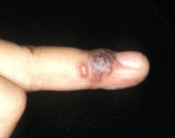 단순포진 손발톱주위염