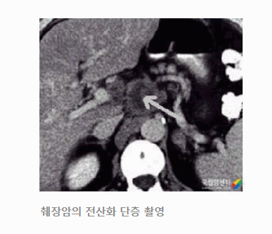 췌장암 초기 증상 총정리 조기 발견과 예방을 위한 완벽 가이드