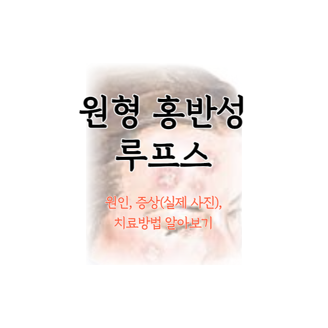 원형-홍반성-루프스