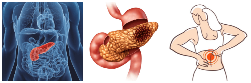 췌장 부위, 췌장암, 등통증 사진