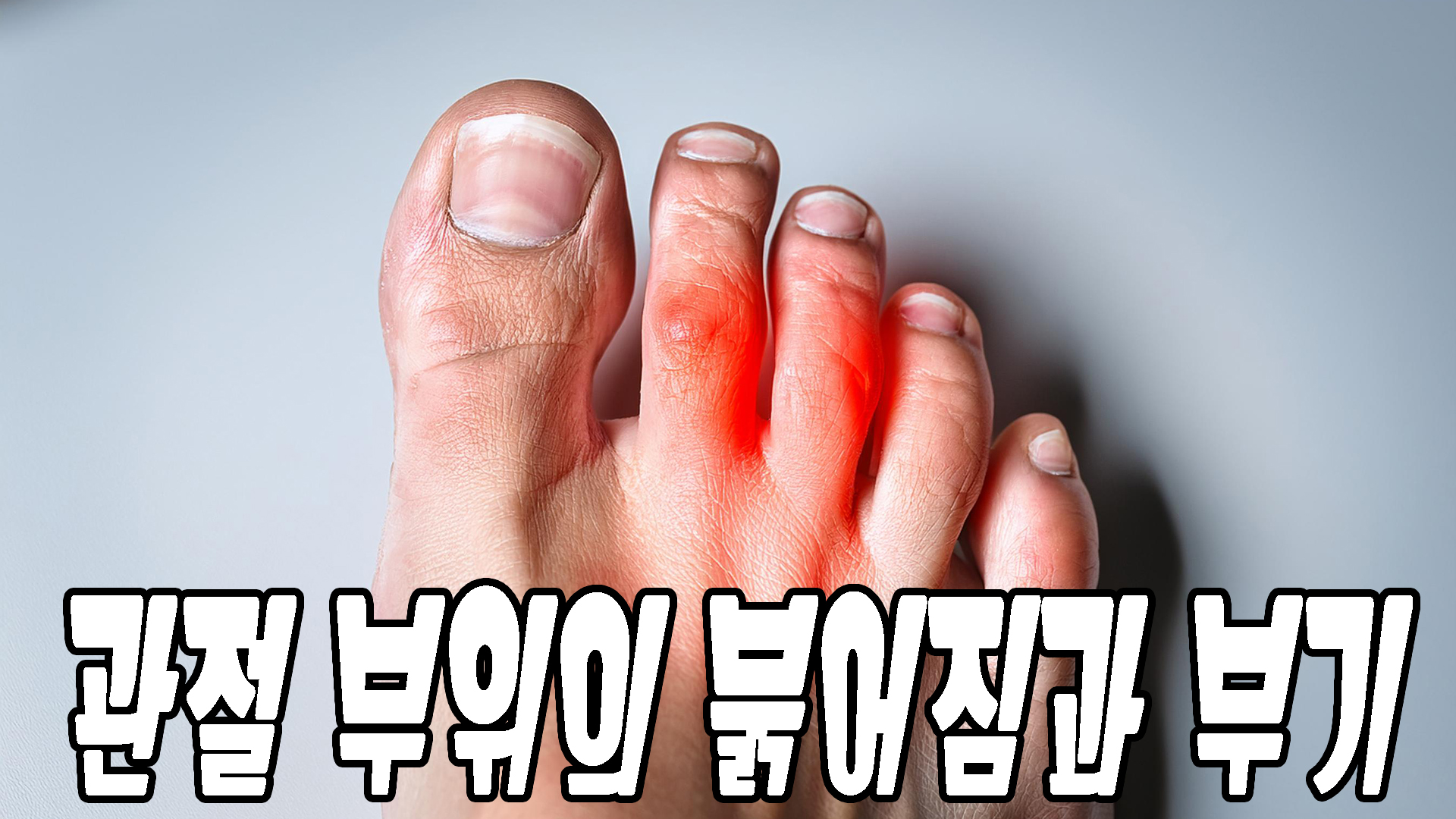 관절 부위의 붉어짐과 부기