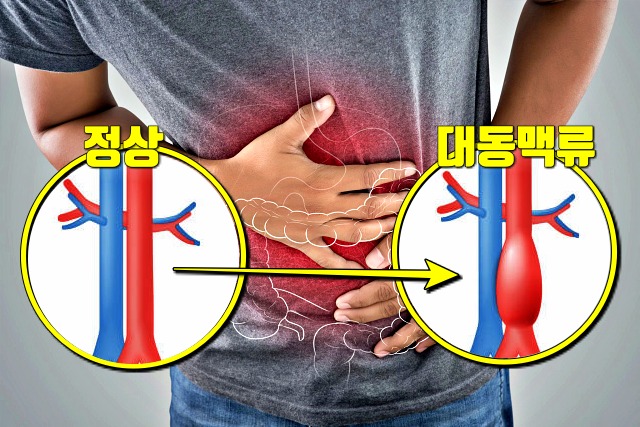 왼쪽 옆구리 통증 의심되는병 혈관 복부 대동맥류 증상, 건강 팁줌 매일꿀정보
