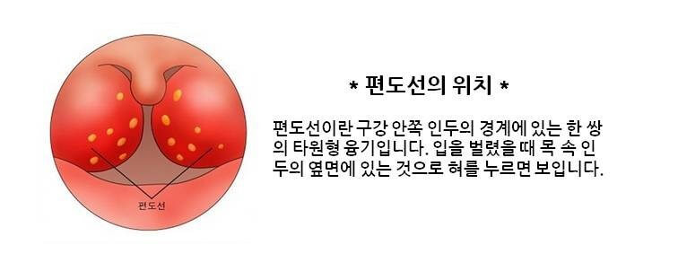 편도선 위치와 염증