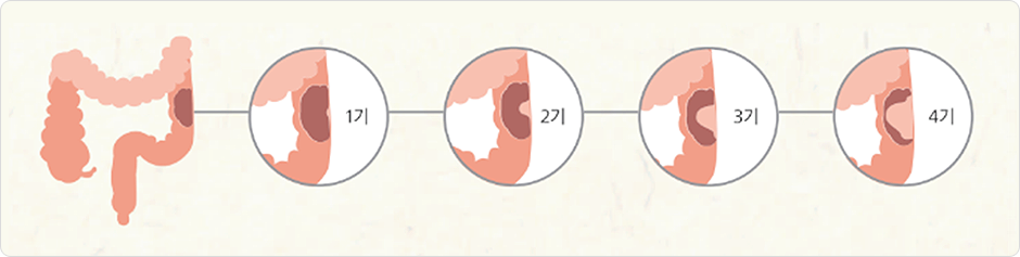 대장-점막에서-발생하는-대장암을-그림으로-표현한-사진