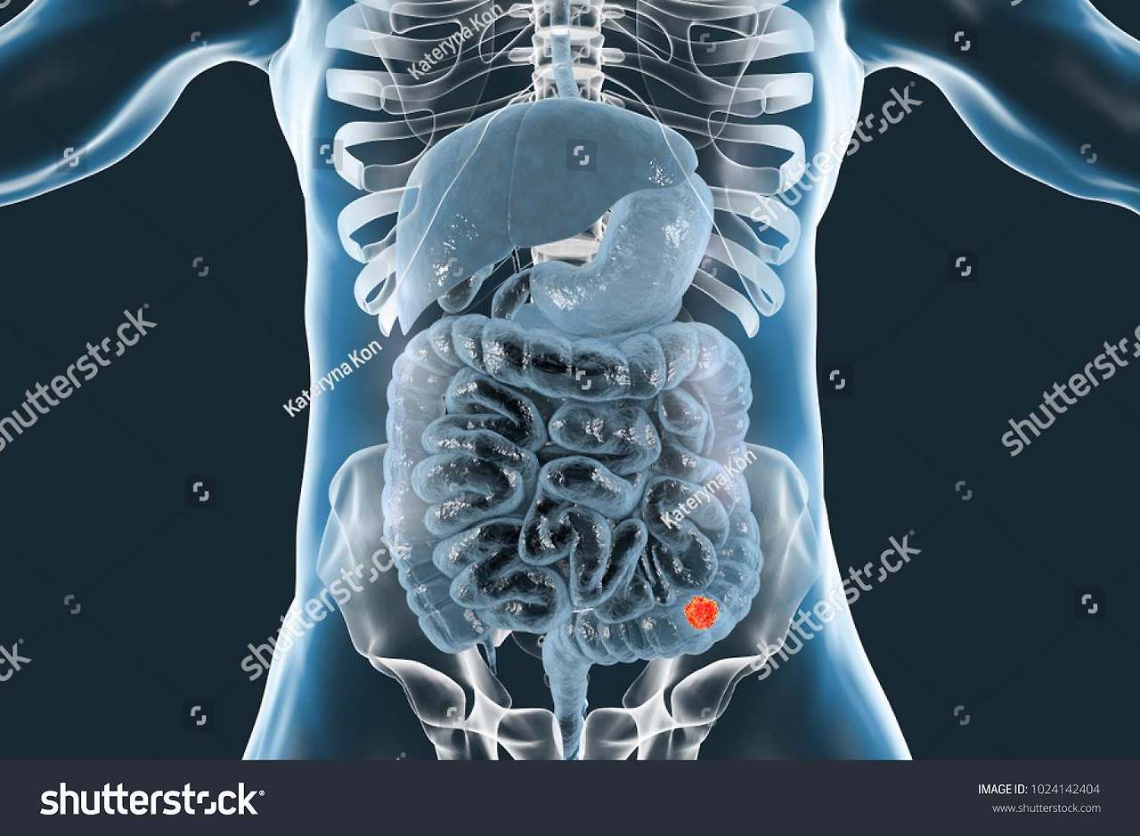 서울대병원 대장암센터 성과