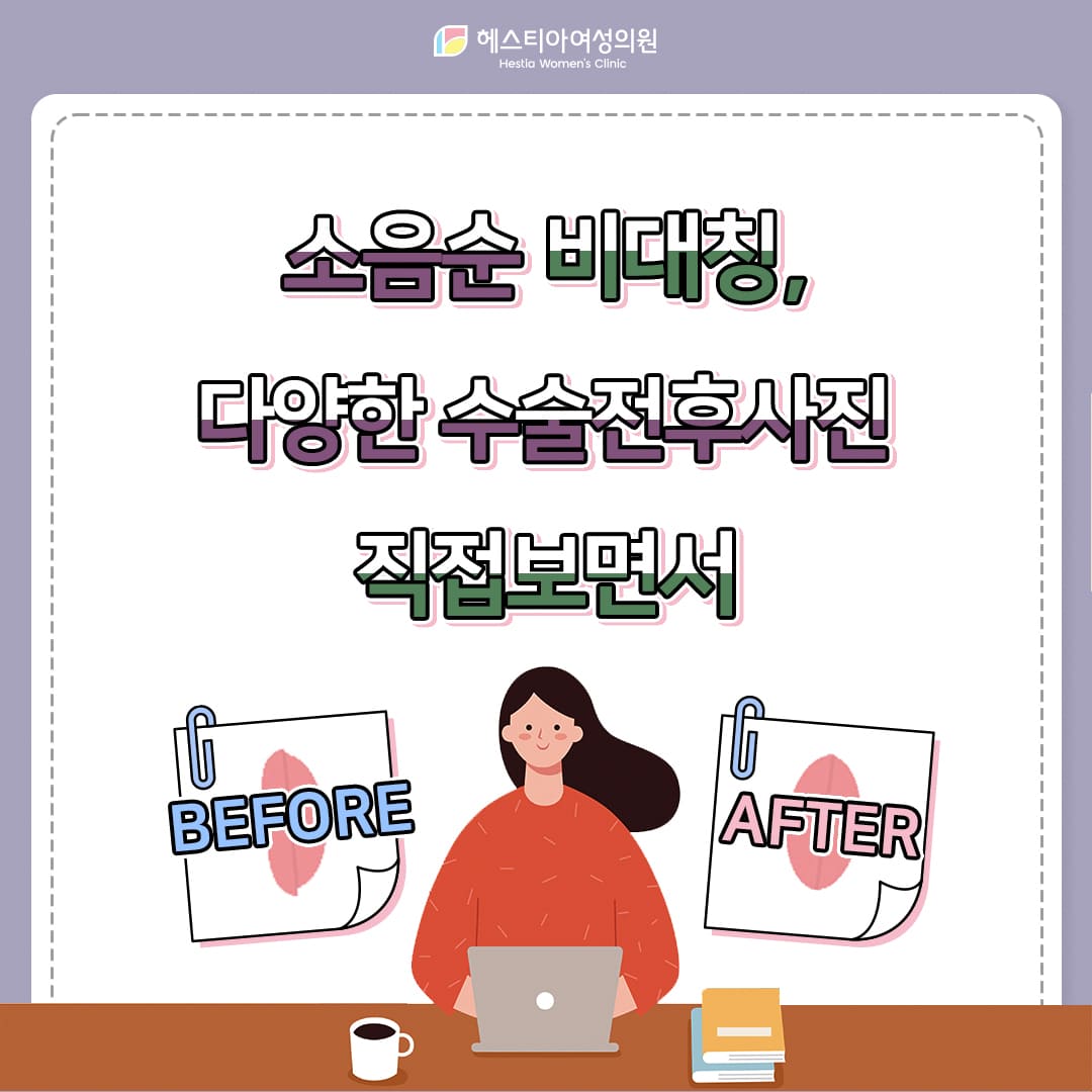 소음순성형 다양한 수술전후사진을 확인해봐야 하는 이유