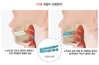 코골이 줄이는 방법과 실전 꿀팁, 건강 관리_40