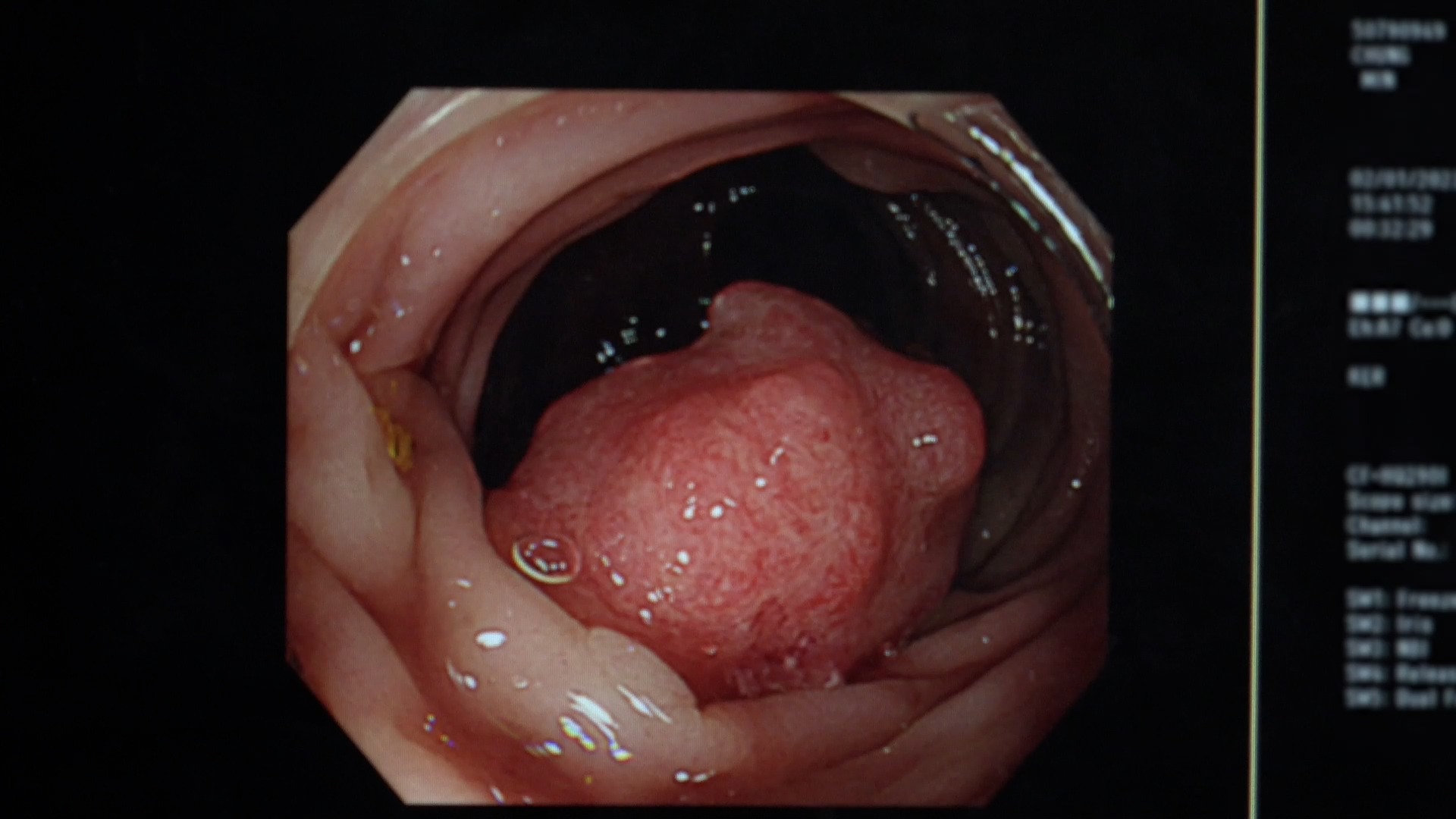 내장지방 체지방 염증 지방 돕는 수국잎 열수 추출물 대표 효능 3가지 및 부작용 알아보기