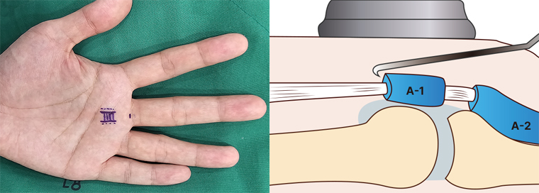 손가락 류마티스 관절염 주요 증상과 체크 리스트